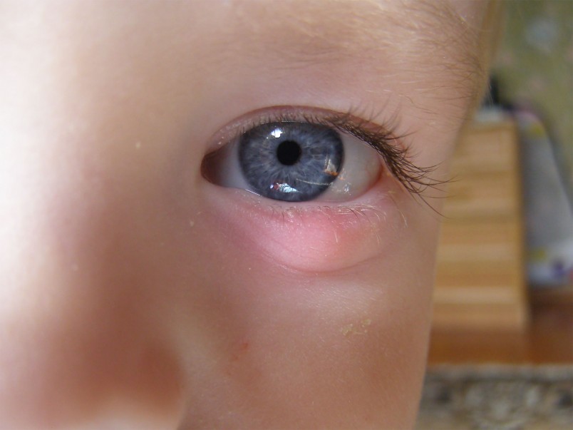 Одной из разновидностей фурункулов является ячмень на глазу. 